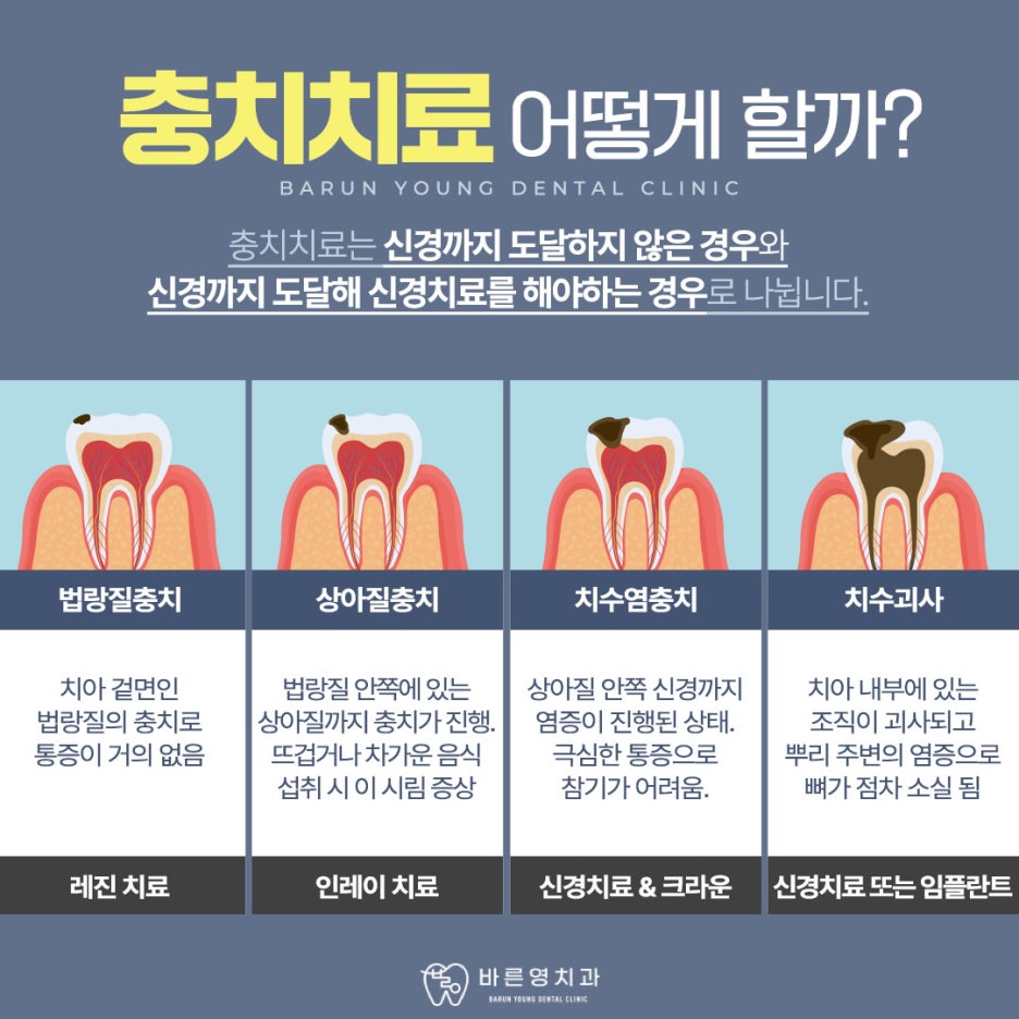 신당역치과 충치치료 자연치아 살리려는 것을 우선으로 관련 이미지 7