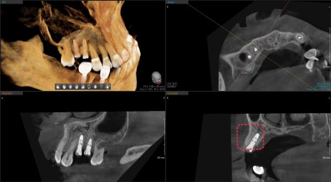 금호동 치과 신경치료된 치아 주변 염증 방치하면 안 되는 이유(발치후 임플란트) 관련 이미지 5
