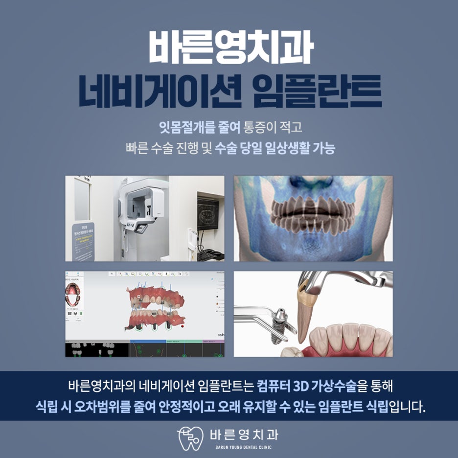 금호역치과 미리 경로 알고 식립하는 네비게이션 임플란트 관련 이미지 9