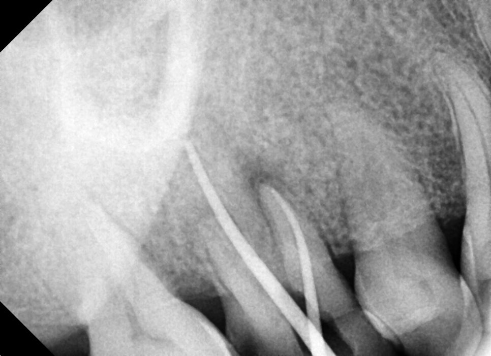약수역치과, 뿌리염증 치아 신경치료하기( 금 간 치아) 관련 이미지 4