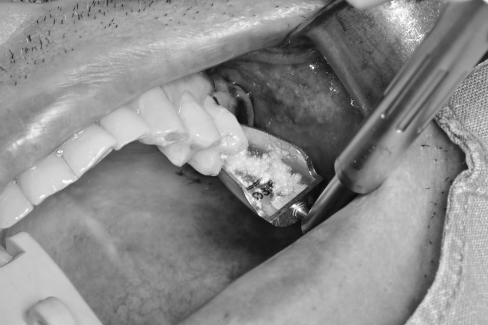 신당동 치과 오래전 빠진 치아 상태에서 임플란트 수술(상악동 거상술) 관련 이미지 7