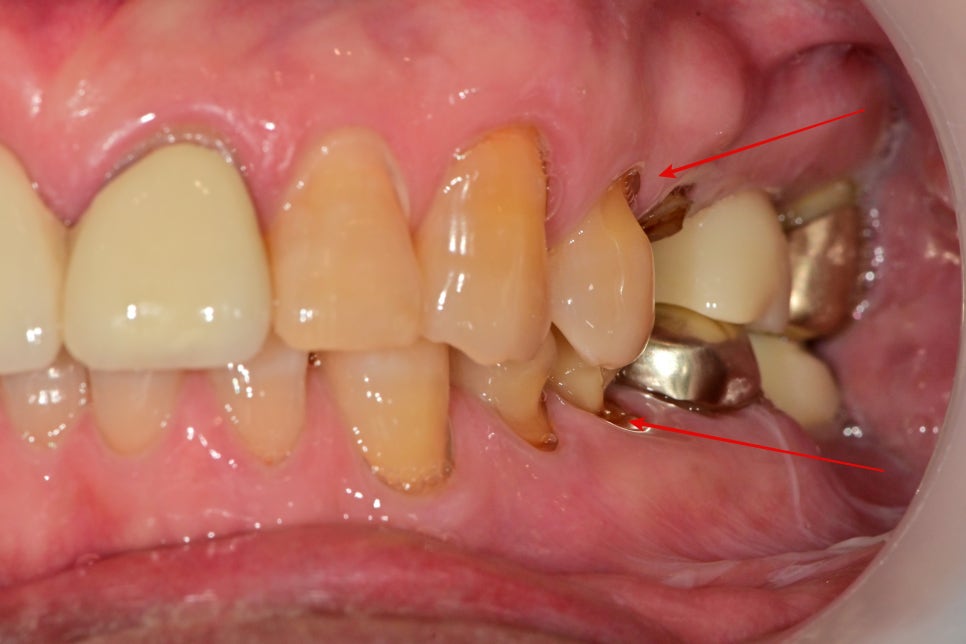 버티고개역 치과 깨지고 닳은 치아 회복하는 방법 관련 이미지 2