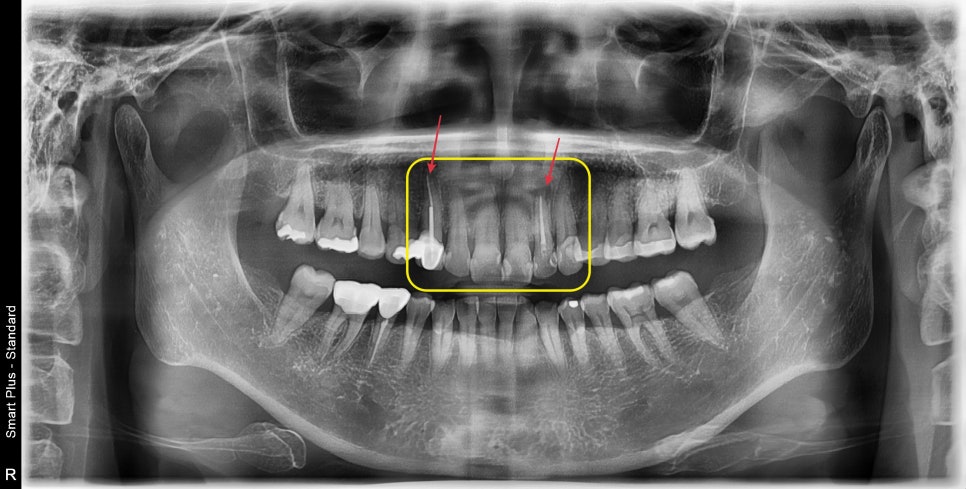 신당동치과 심미보철을 이용한 고른 앞니 만들기 관련 이미지 4