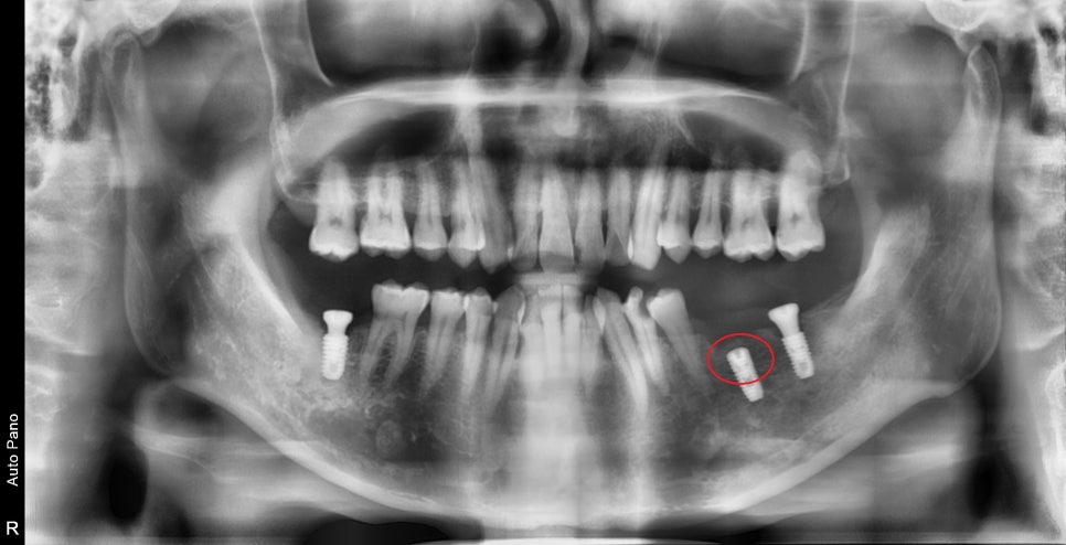 약수역 치과, 미뤄둔 임플란트 치료하기 (치과가 무서워요) 관련 이미지 6