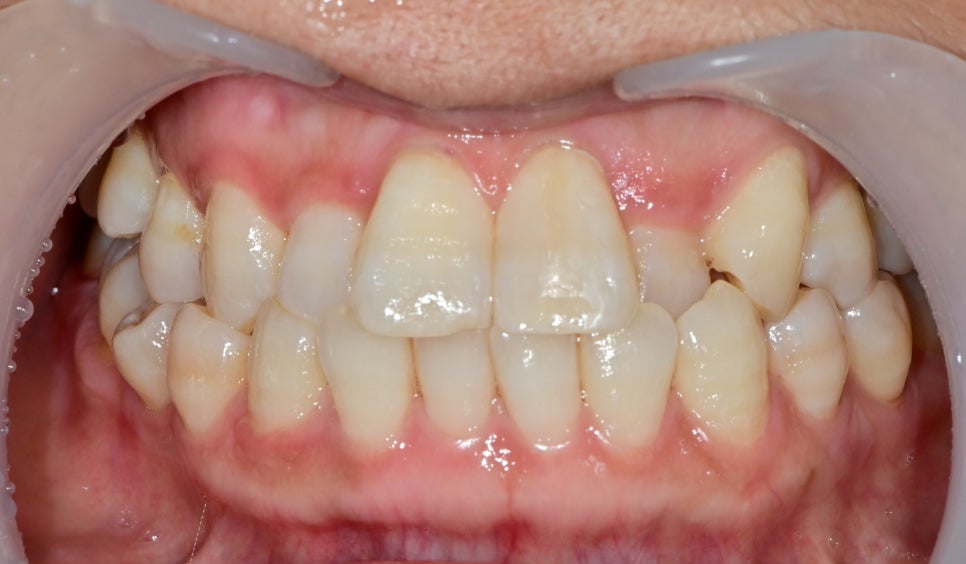 약수역 치과 벌어진 앞니, 금간앞니(크랙) 레진을 이용한 치료 관련 이미지 4