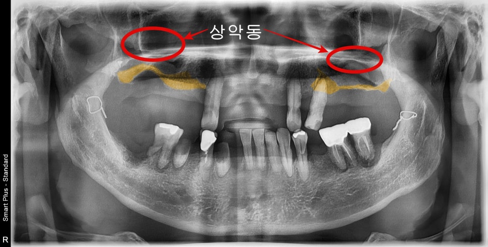 약수역치과 전체임플란트 진행과정 (상악동 거상술) 관련 이미지 2