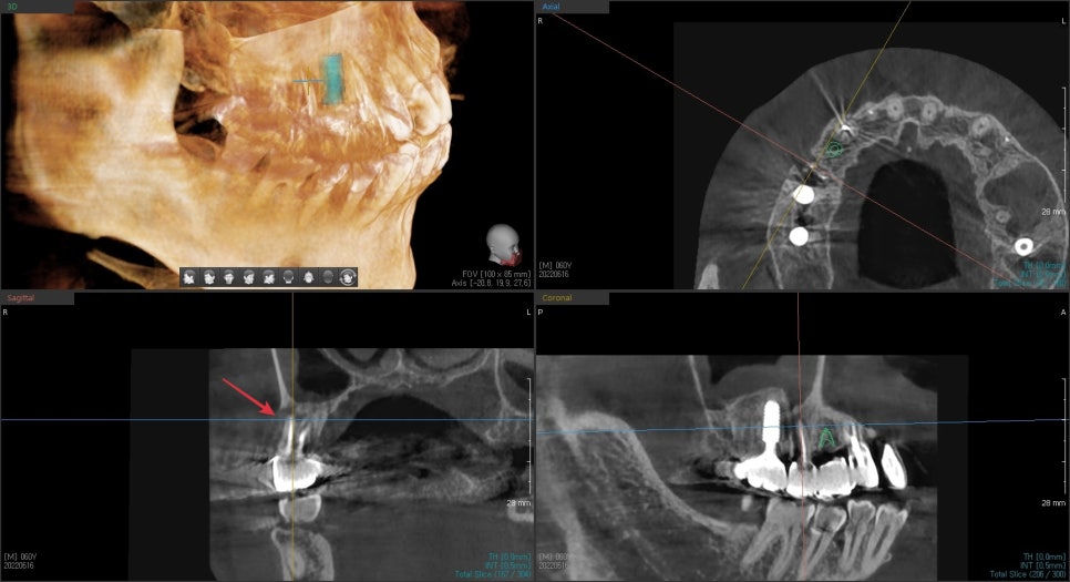 금호동 치과 신경치료된 치아 주변 염증 방치하면 안 되는 이유(발치후 임플란트) 관련 이미지 8