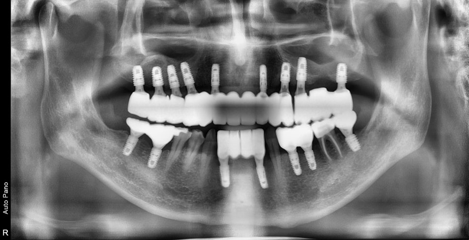 약수역 치과 비염 수술 후 상악동 임플란트 과정 관련 이미지 7