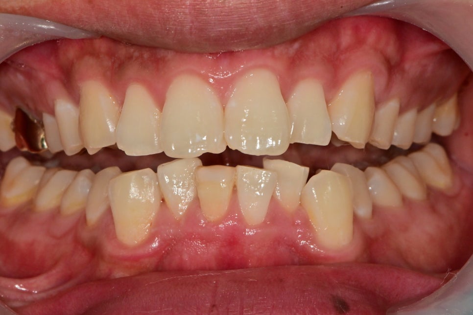 약수역 치과, 신경치료 시작 후 장기간 중단되었을 때 생길 수 있는 증상은?? 관련 이미지 5