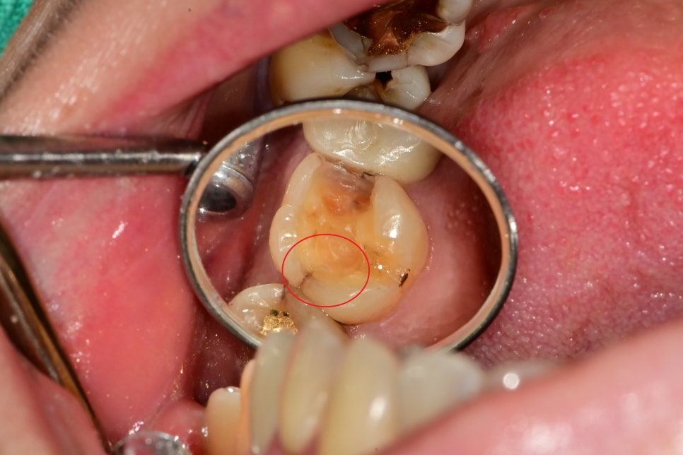 약수역 치과, 금간 치아는 신경치료를 꼭 해야 하나요?( 임플란트 전 크라운치료, MTA) 관련 이미지 4