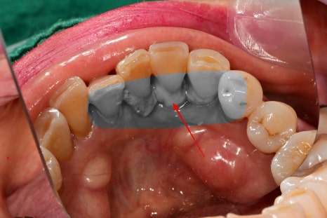 약수역 치과, 양치질 할때 피나고 냄새나는 잇몸병 관리 방법(워터픽, 먹는약) 관련 이미지 4