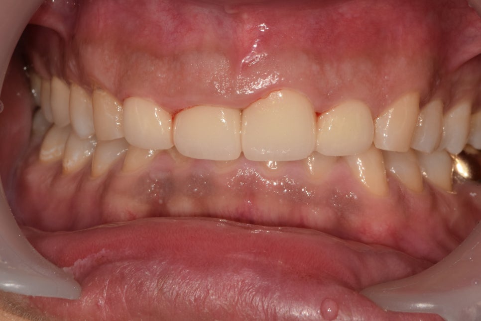 약수동 치과, 삐뚤어진 앞니가 충치가 생겨 치료 후 보철로 가지런한 치아 만들기 관련 이미지 6