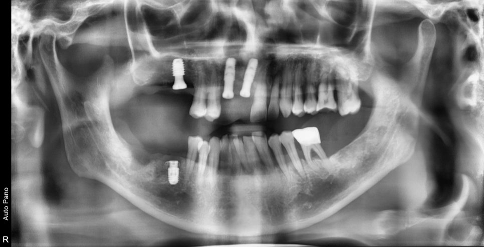 청구역 치과 치주염으로 다수의 치아가 흔들리는 경우(발치, 임플란트) 관련 이미지 10