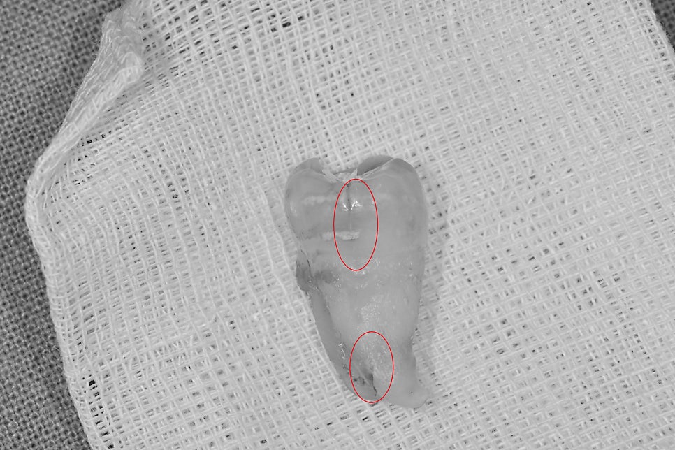 약수역 치과, 금 간 치아( 크랙 치아)로 인한 뿌리 주변 염증이 생겼을 때 치료방법( 임플란트, 치조골 이식술) 관련 이미지 3