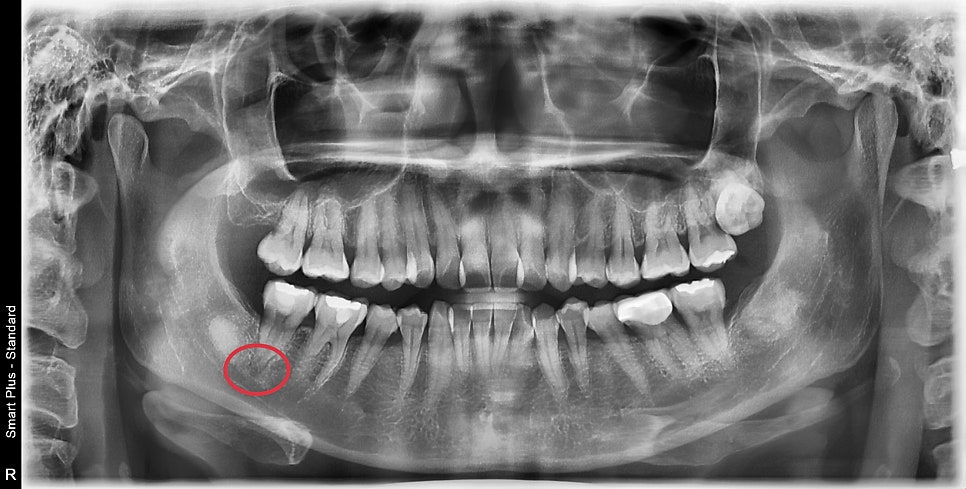광희동 주변 치과 치아 크랙으로 인한 증상 신경치료 관련 이미지 1