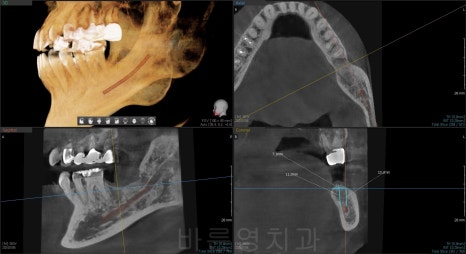 신당역 치과, 임플란트를 수술을 위해 사랑니는 꼭 빼야 하나요?? (얼마나 기다려야 임플란트 치료가 가능한가요?) 관련 이미지 7