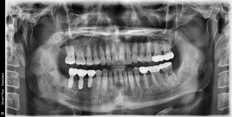 동대문 치아뿌리 염증 방치하면 치과 임플란트 기간에 영향을 줍니다 관련 이미지 8
