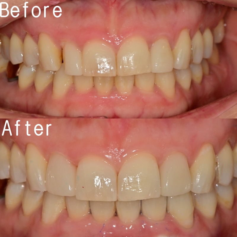 동대입구역 주변 치과 라미네이트가 깨지는 이유 관련 이미지 7