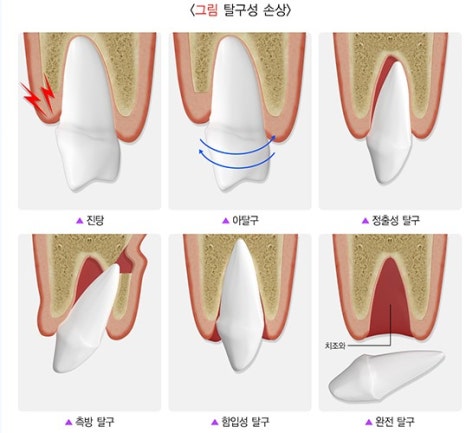 버티고개역 치과 앞니 외상에 따른 치료방법( 넘어져서 치아가 부러졌어요) 관련 이미지 2