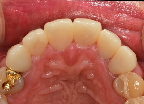 신당동치과 심미보철을 이용한 고른 앞니 만들기 관련 이미지 7
