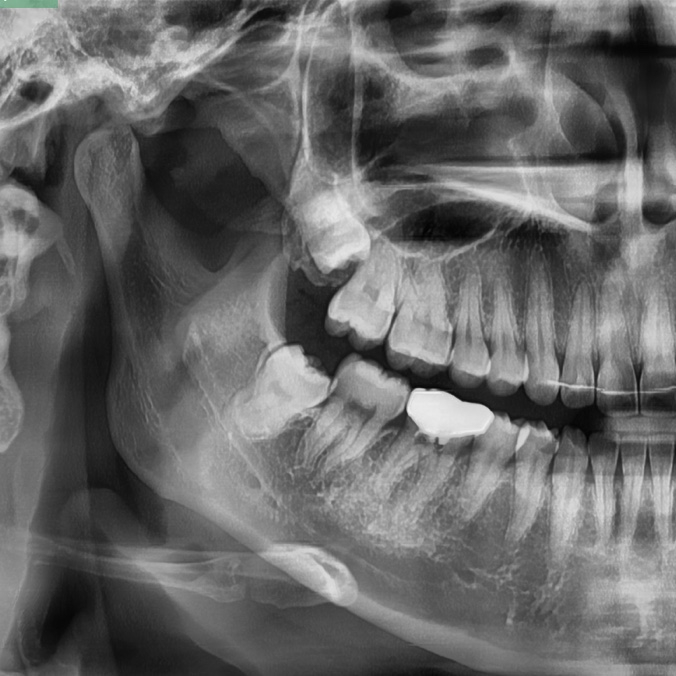 약수치과, 통증 있다면 사랑니발치 미루지 마세요 관련 이미지 7