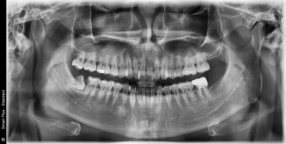 약수역 치과, 매복 사랑니 발치 (신경치료, 크라운치료) 관련 이미지 1