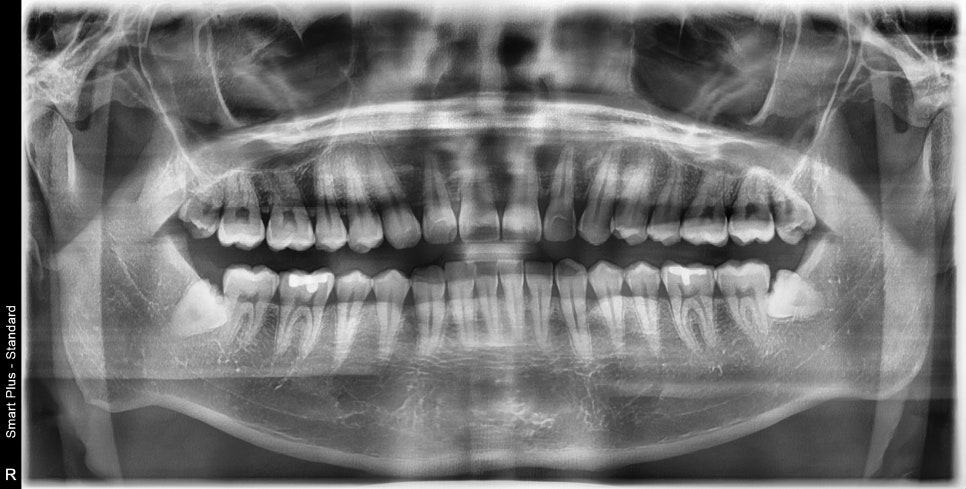 금호동 치과, 사랑니 때문에 주변 잇몸이 붓는 이유 (매복 사랑니 주변 치은염) 관련 이미지 1