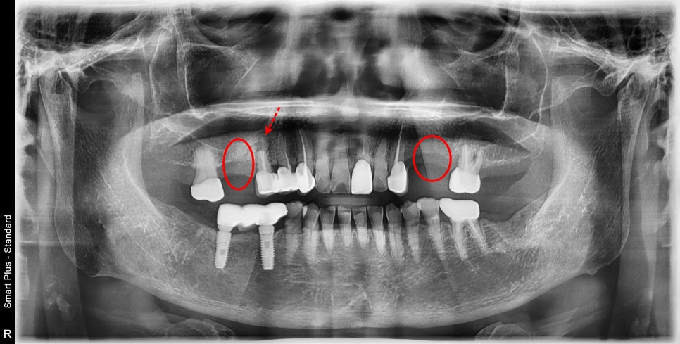 신금호 치과 , 틀니를 오래 쓰면 치아에 생기는 문제점 관련 이미지 1