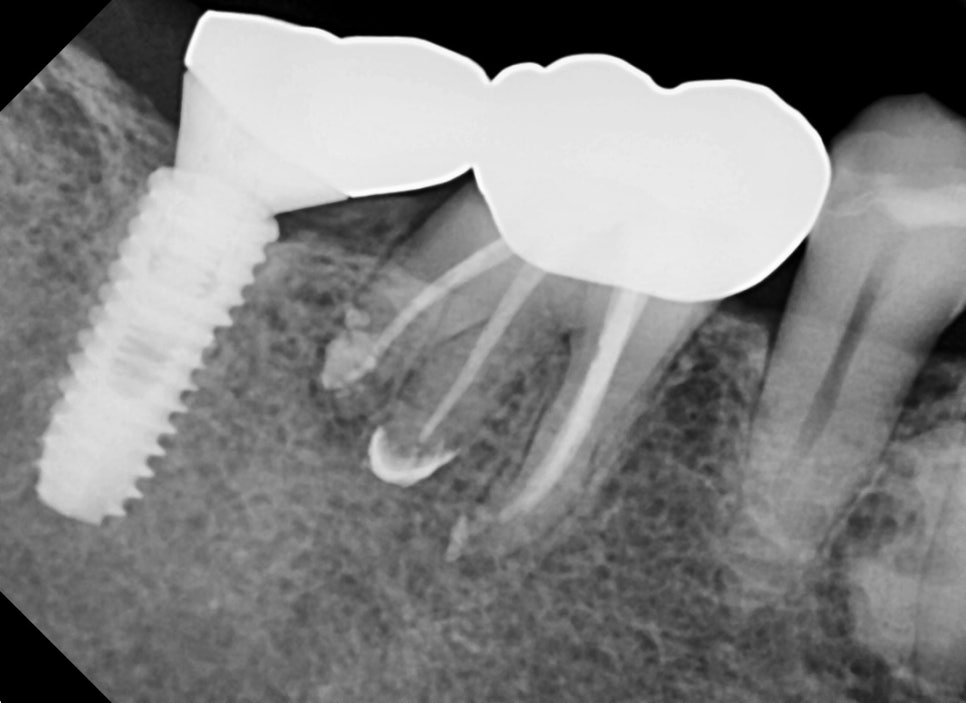 옥수동 크라운치료된 통증 있는 치아의 (재)신경치료 과정 관련 이미지 6