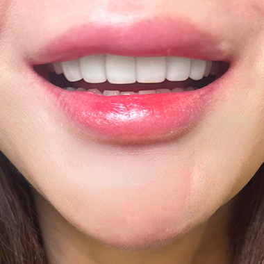 동대문 무삭제라미네이트 과거 교정한 치아가 웃을 때 안 보여 스트레스일 때 관련 이미지 9