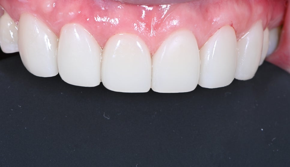 동대문 무삭제라미네이트 과거 교정한 치아가 웃을 때 안 보여 스트레스일 때 관련 이미지 7