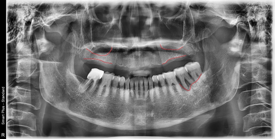 금호역 치과, 전체 틀니 대신 전체 임플란트로 가는 기간(식립위치의 선정의 중요성) 관련 이미지 1