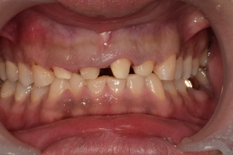약수동 치과, 삐뚤어진 앞니가 충치가 생겨 치료 후 보철로 가지런한 치아 만들기 관련 이미지 2