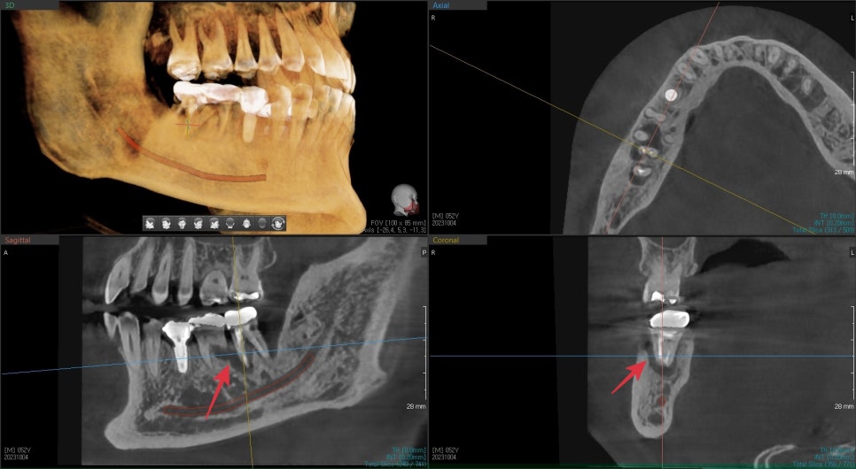 동대문 치아뿌리 염증 방치하면 치과 임플란트 기간에 영향을 줍니다 관련 이미지 3