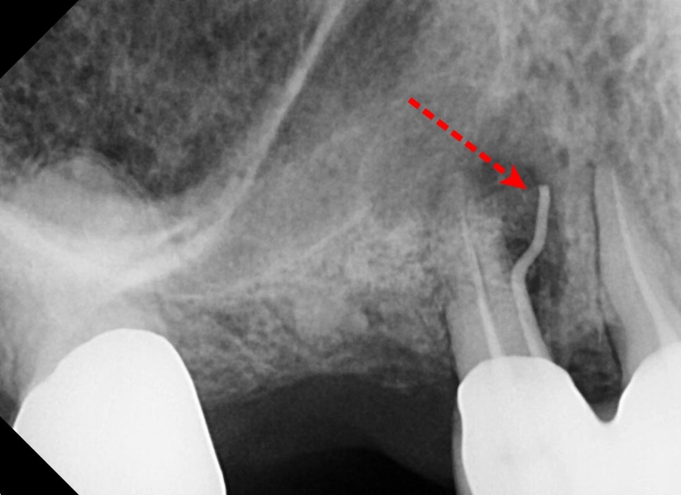 신금호 치과 , 틀니를 오래 쓰면 치아에 생기는 문제점 관련 이미지 2