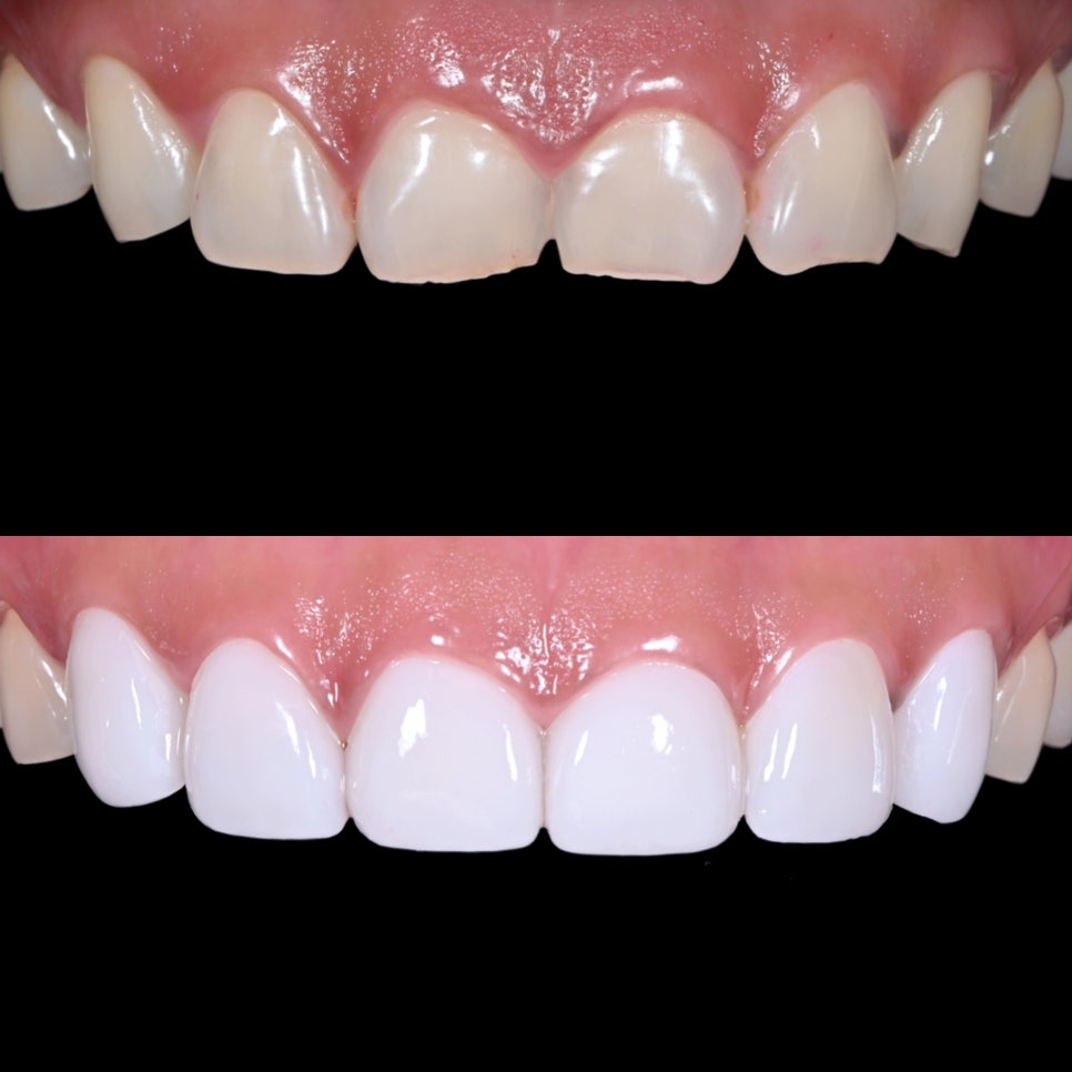 약수역 치과 라미네이트를 하고싶다면 이것부터 이해하면 좋습니다(밝은 미소를 되찾아가는 과정) 관련 이미지 3