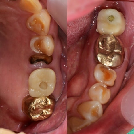 버티고개역 치과 깨지고 닳은 치아 회복하는 방법 관련 이미지 5
