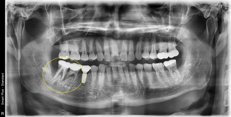 약수역 임플란트, 발치 후 임플란트 수술 언제 가능한가? 관련 이미지 1