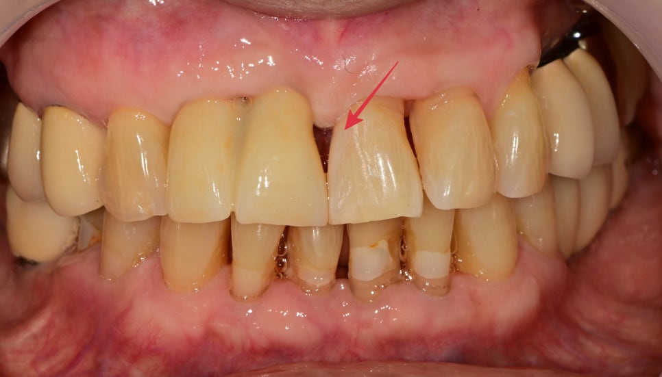 약수동 치과 내려앉은 잇몸 공간 치아삭제 없이 치료하기 관련 이미지 7