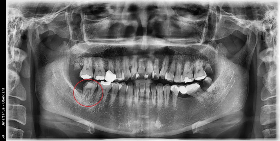 약수역 치과, 금간 치아는 신경치료를 꼭 해야 하나요?( 임플란트 전 크라운치료, MTA) 관련 이미지 1