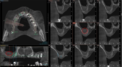 약수역 치과 비염 수술 후 상악동 임플란트 과정 관련 이미지 4