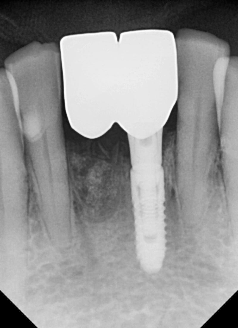 성동구 옥수동 치과 앞니 임플란트수술 즉시 임시치아 제작(구강스캐너를 이용한 수술절차) 관련 이미지 9