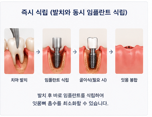 약수역 치과 발치후 임플란트 식립시기는 어떻게 정해질까요? 관련 이미지 4
