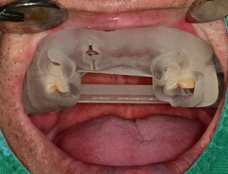 한남동 주변 치과 구강 스캐너를 이용한 가이드 임플란트 수술(무절개 수술) 관련 이미지 5