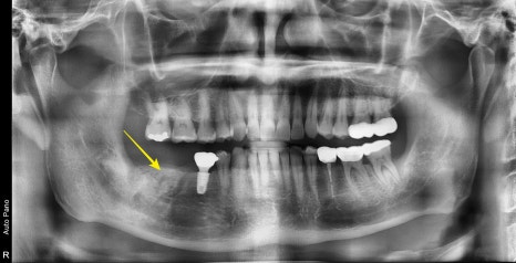 동대문 치아뿌리 염증 방치하면 치과 임플란트 기간에 영향을 줍니다 관련 이미지 5