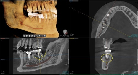 약수역 임플란트, 발치 후 임플란트 수술 언제 가능한가? 관련 이미지 2