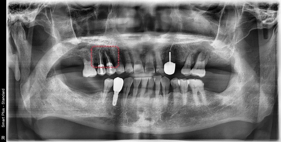 금호동 치과 신경치료된 치아 주변 염증 방치하면 안 되는 이유(발치후 임플란트) 관련 이미지 1