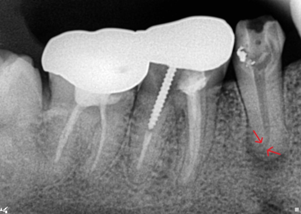 약수역 치과 오래된 신경치료 다시 하기 관련 이미지 3