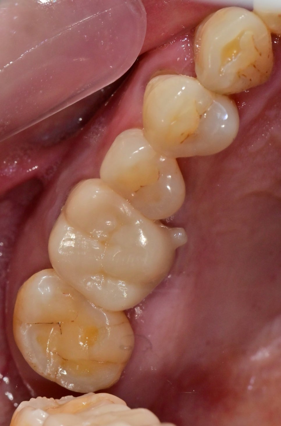 약수역치과, 뿌리염증 치아 신경치료하기( 금 간 치아) 관련 이미지 6