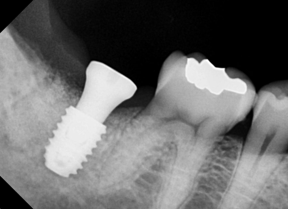 약수역 치과, 금 간 치아( 크랙 치아)로 인한 뿌리 주변 염증이 생겼을 때 치료방법( 임플란트, 치조골 이식술) 관련 이미지 5